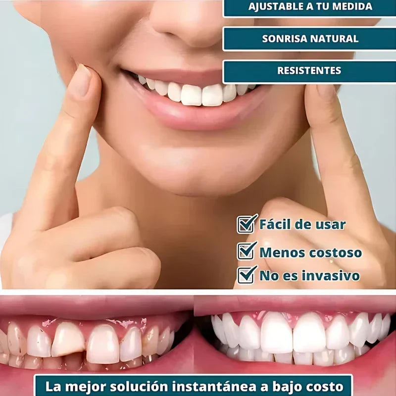 SmilePro 🦷 - Carillas Dentales Ajustables de Resina + ESTUCHE DE REGALO - ¡Últimas unidades!